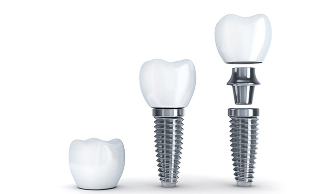 Dental Implants